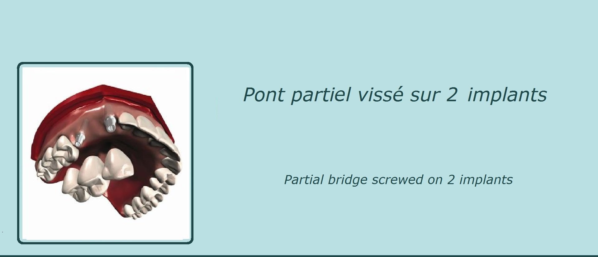 image représentant un pont partiel vissé sur 2 implants