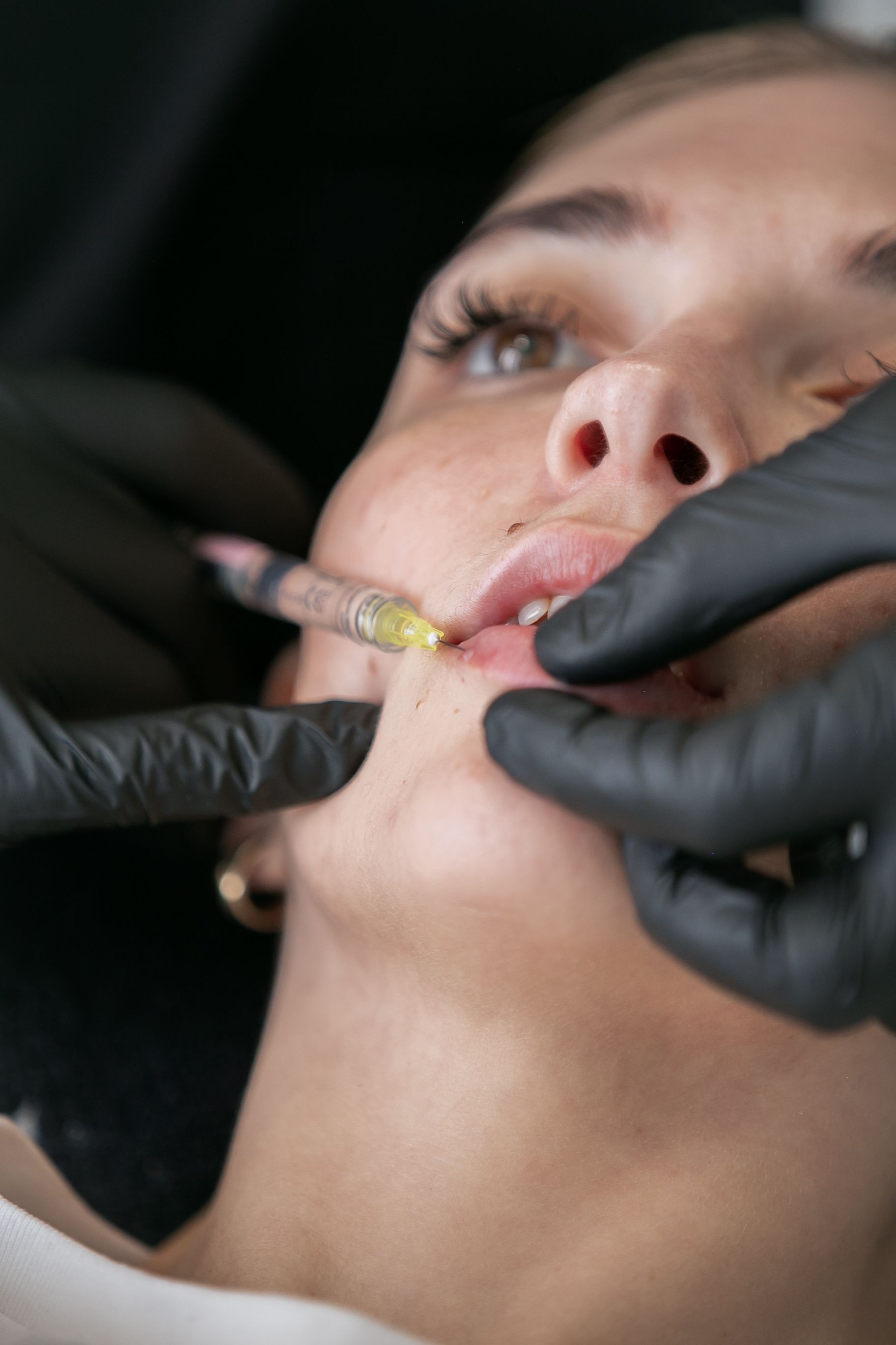A woman is getting a botox injection in her lips.