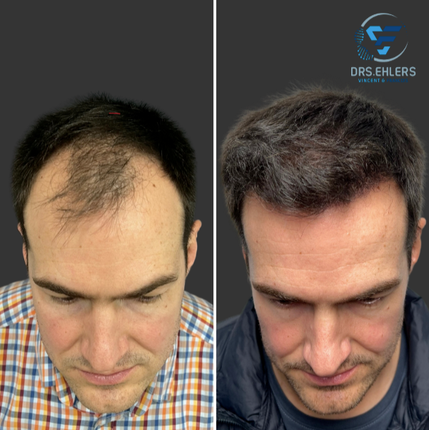 A before and after photo of a man 's hair