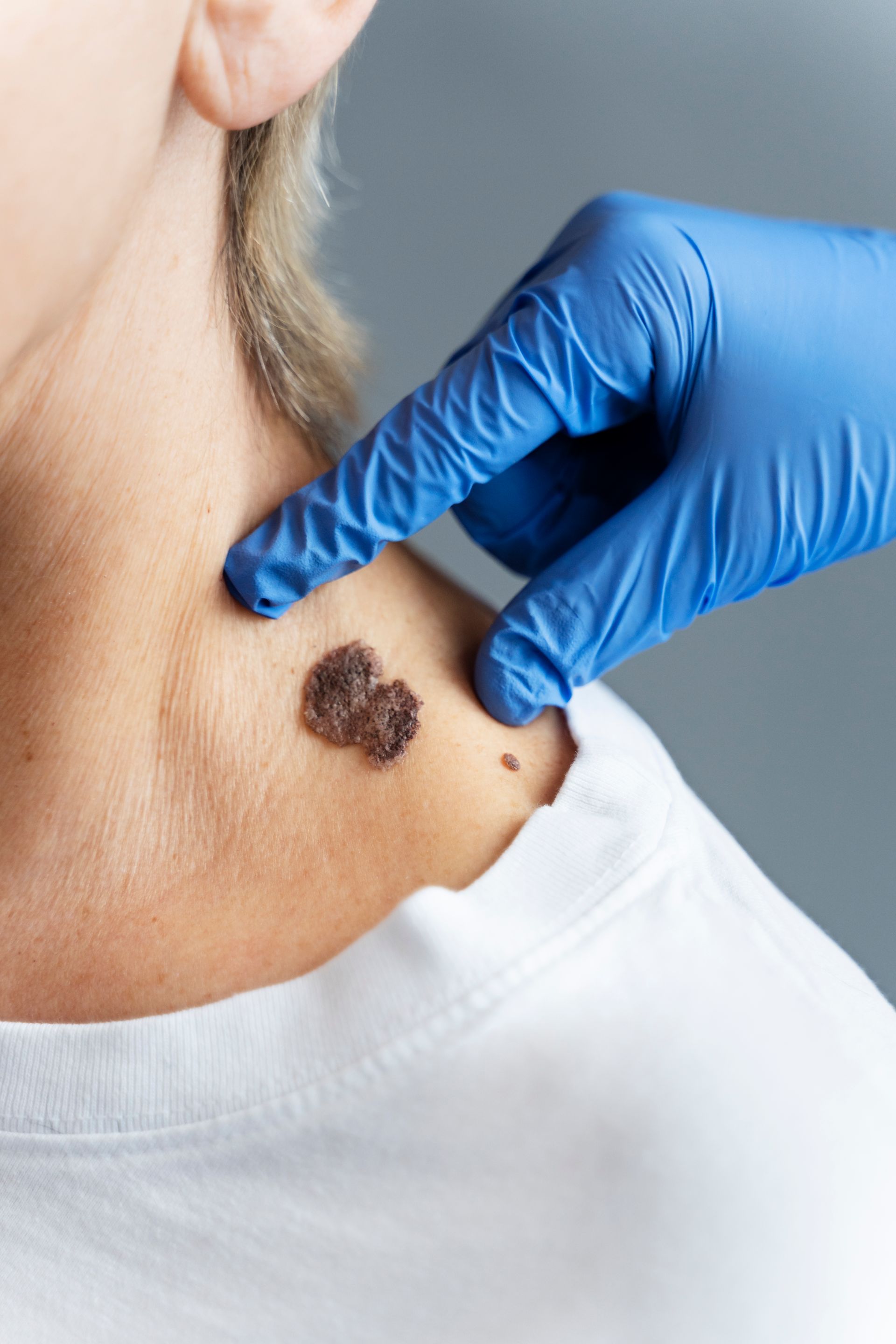 A woman is being examined by a doctor who is wearing blue gloves.