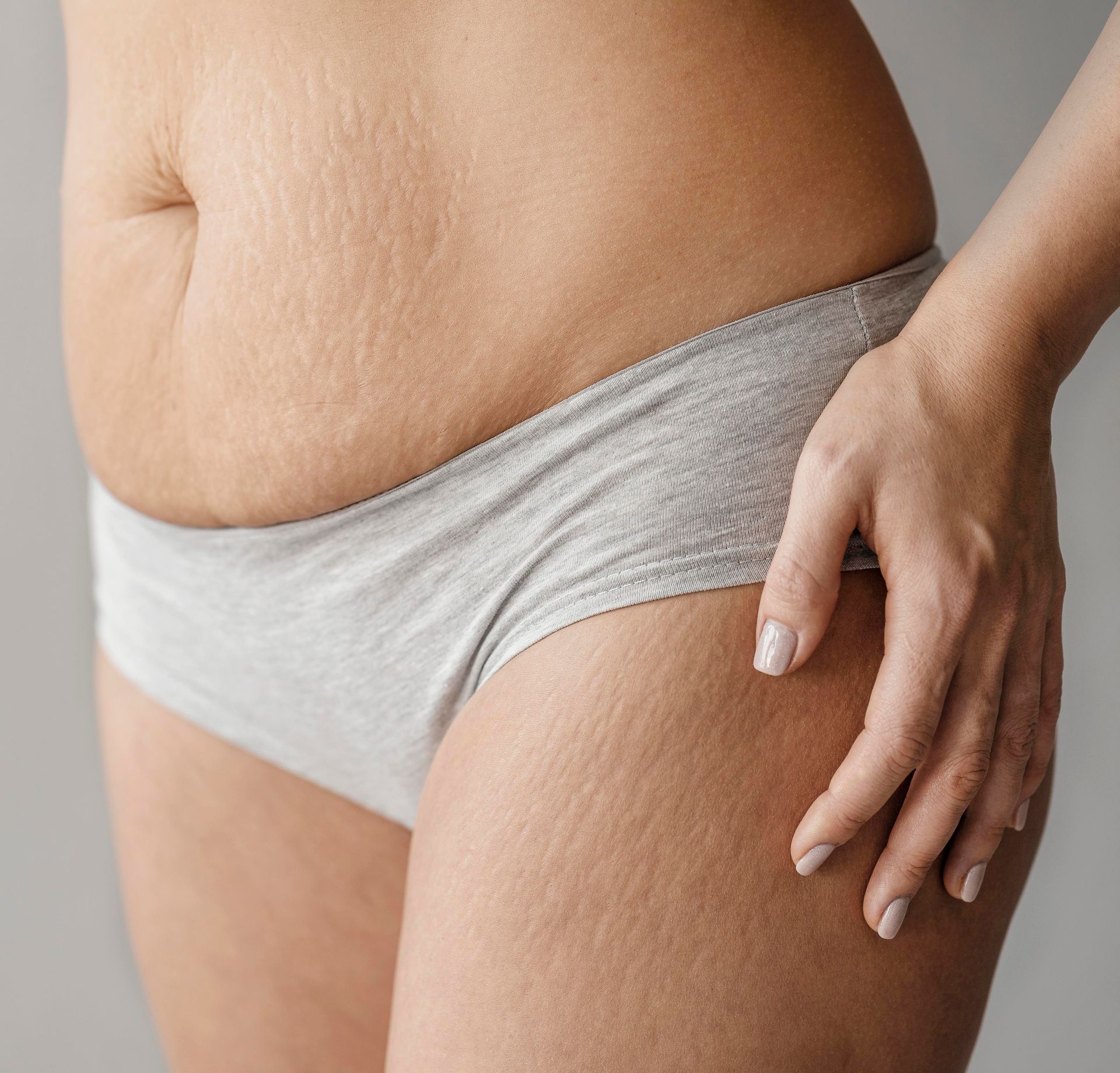 A woman in underwear has stretch marks on her stomach.