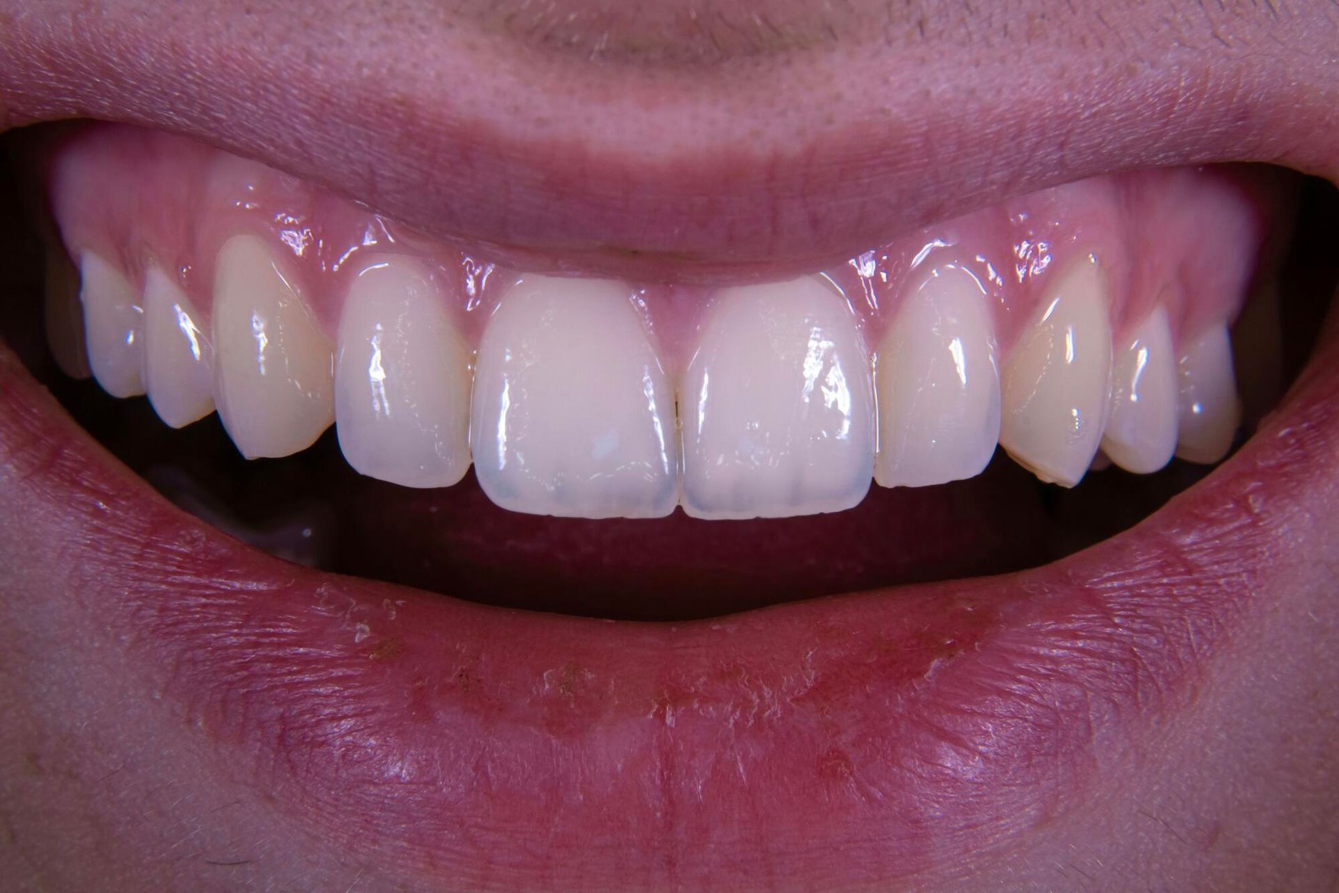 A close up of a person 's teeth with a smile on their face.