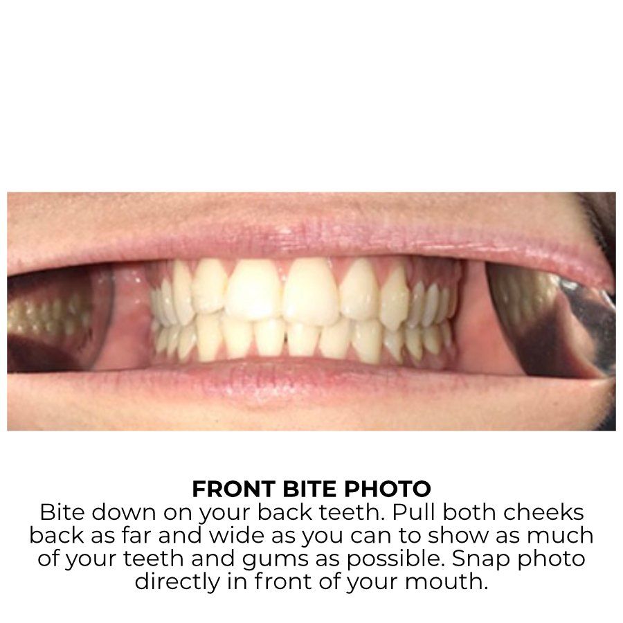 Front Bite Example