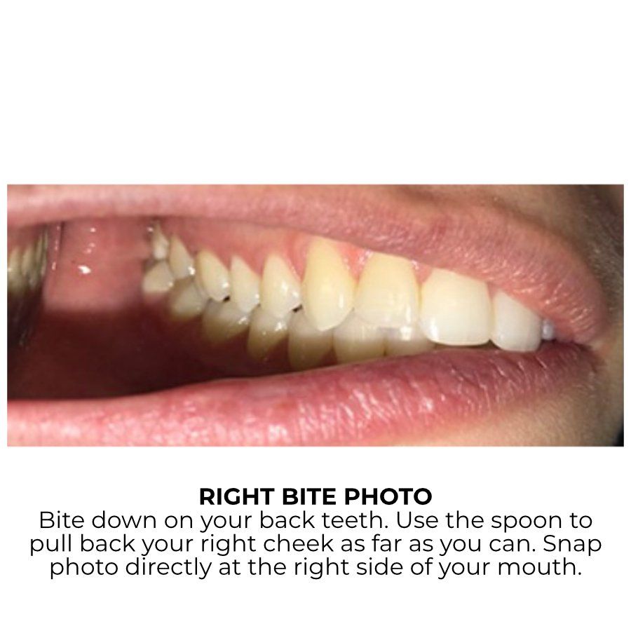 Right Bite Example