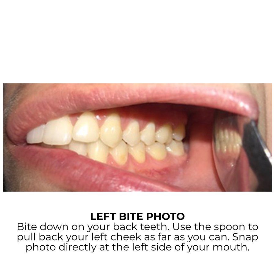Left Bite Example
