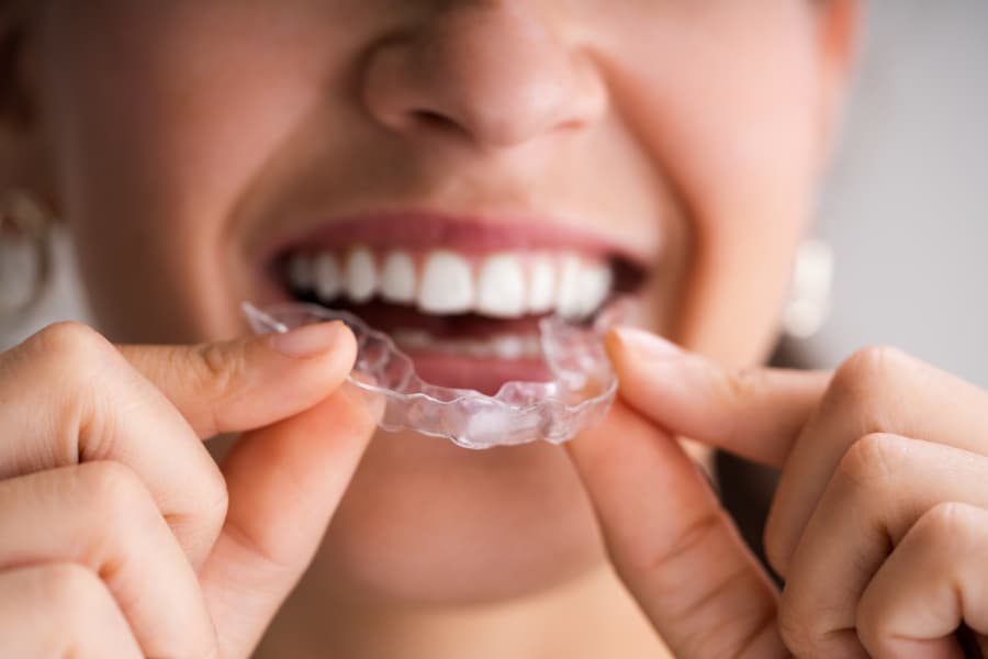 Close up of woman inserting clear dental aligner