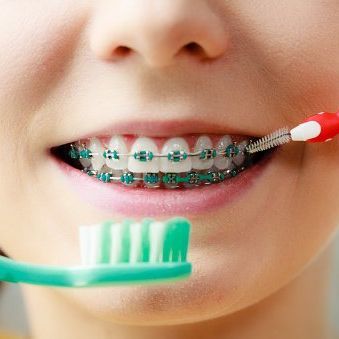 Girl with braces brushing her teeth