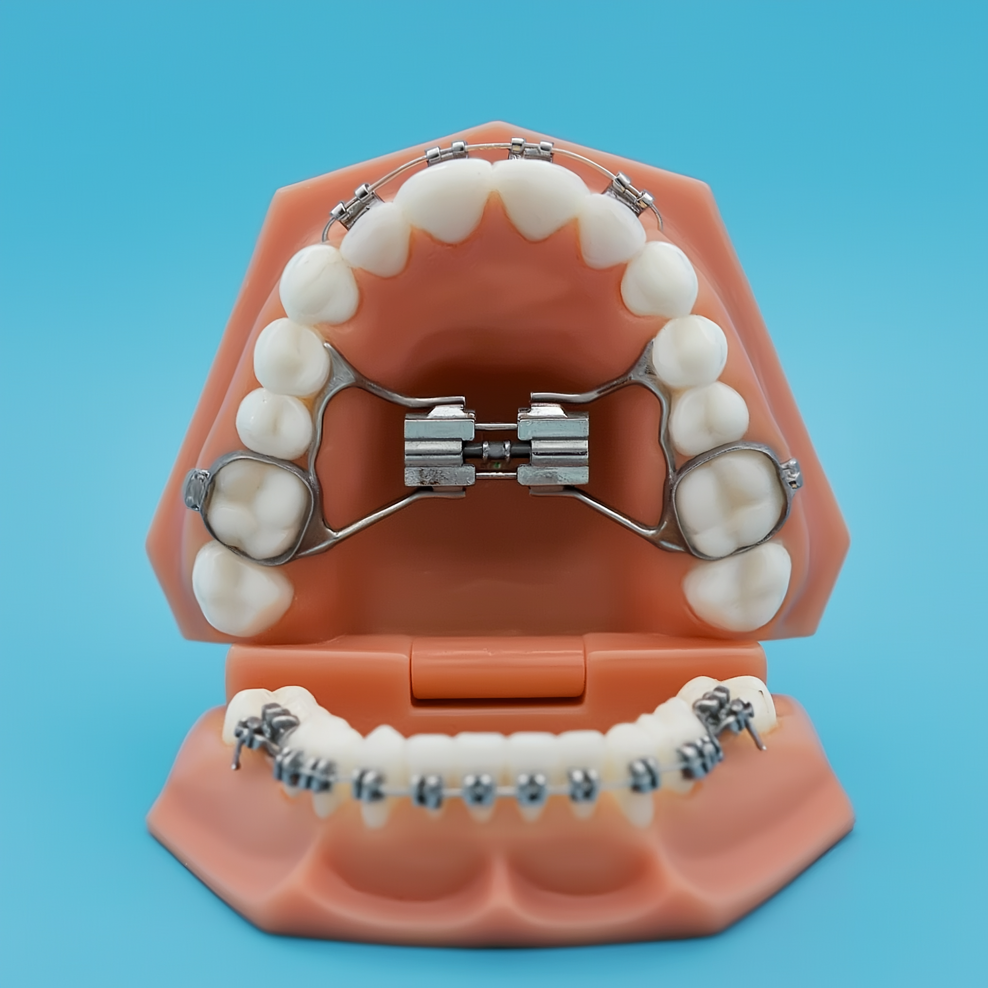 Why Early Palate Expansion Matters For Growing Smiles At Island Orthodontics