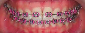 braces with pink rubber bands for breast cancer awareness month
