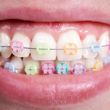 Cool Colors for Cool Smiles:  Putting the Fun in Braces Treatment
