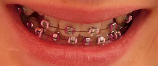 braces with red and pink rubber bands for Valentine's Day