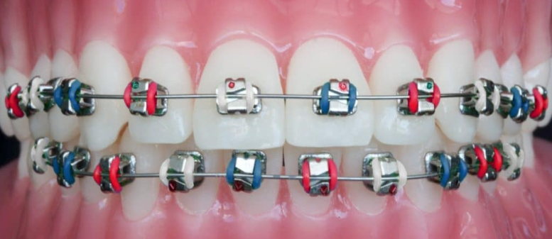 braces with red, white and blue rubber bands for New Year, 4th of July or Memorial Day celebration