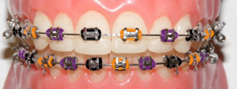 braces with orange, black and purple rubber bands for Halloween