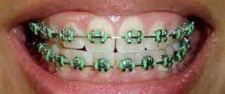 braces with green rubber bands for St. Patrick's Day