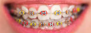 braces with red, range and yellow rubber bands for Autumn