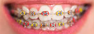 Braces Rubber Band Color Combinations for the Holidays! l Dr. Alkhoury