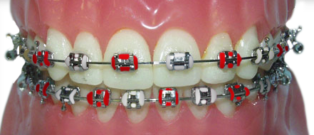 braces with red and white rubber bands for the Alabama Crimson Tide