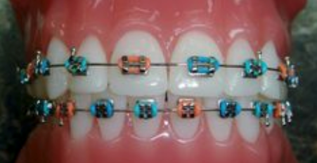 braces with the colors of the Miami Dolphins