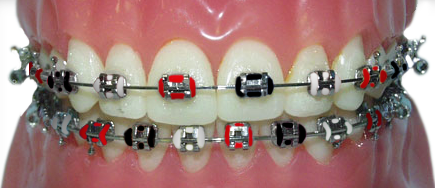 braces with red, black and white rubber bands for the Atlanta Falcons