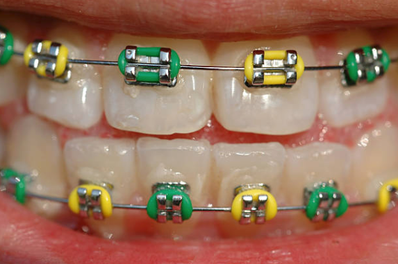 braces with green and yellow rubber bands for the Green Bay Packers