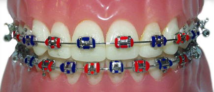 braces with red and navy rubber bands for the Atlanta Braves