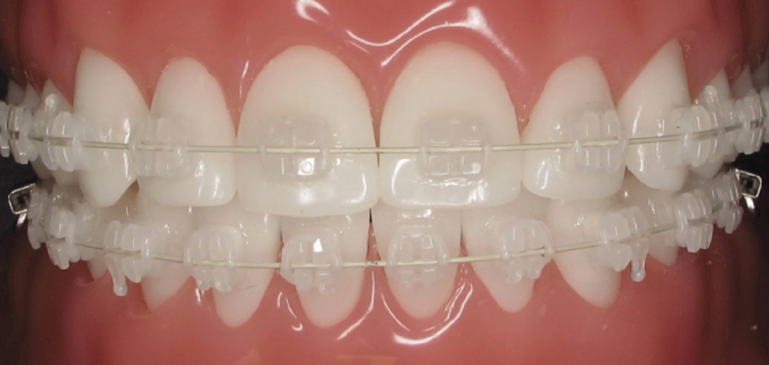 braces with transparent rubber bands for a more subtle look