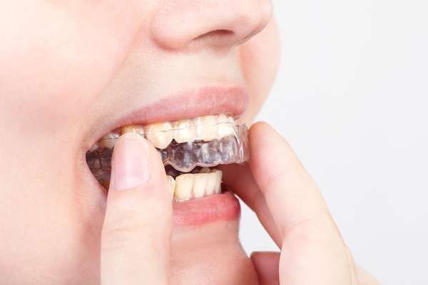 5 Things You May Not Have Known About Clear Braces
