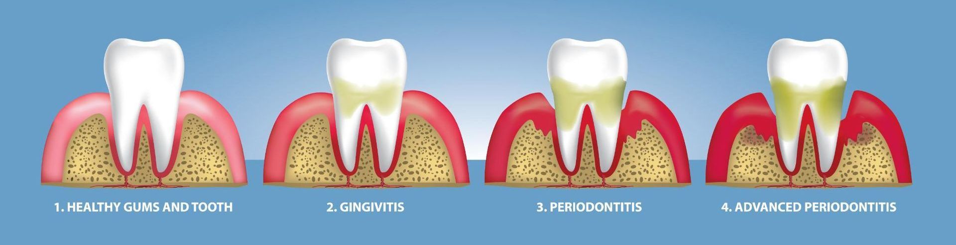 A diagram showing the different stages of tooth decay.