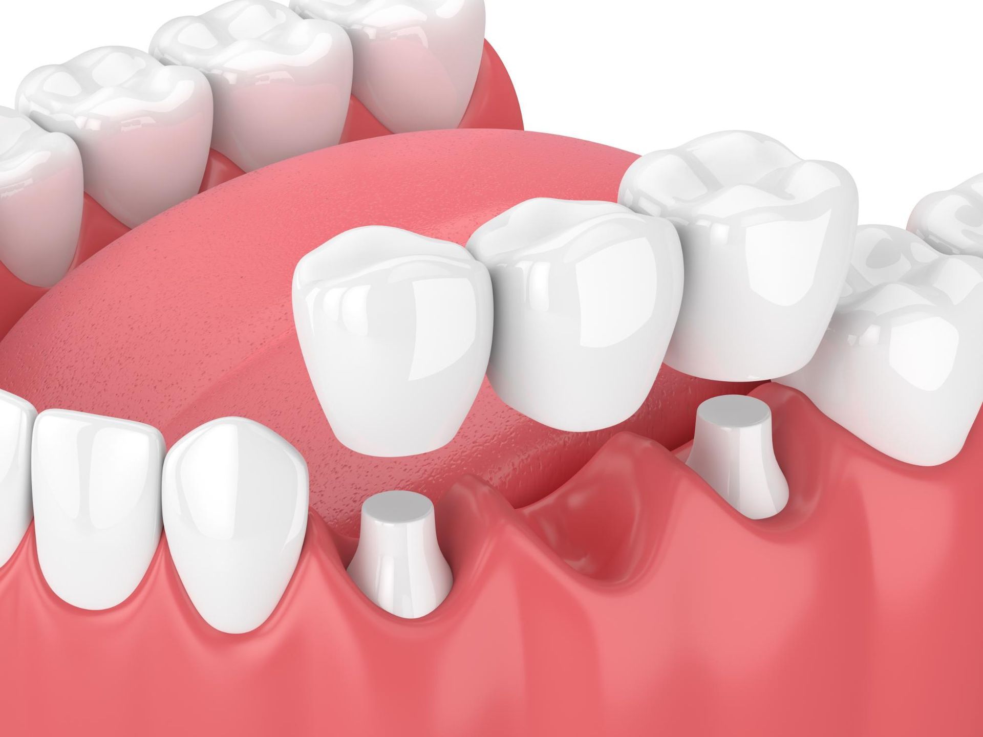 A 3d rendering of a dental bridge in a person 's mouth.