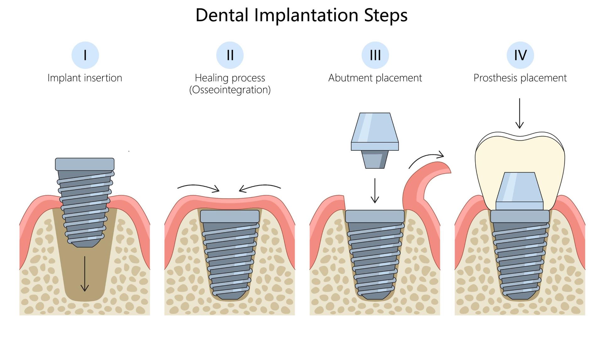Step By Step Denture Process – Traditional Dentures – HXYIMD