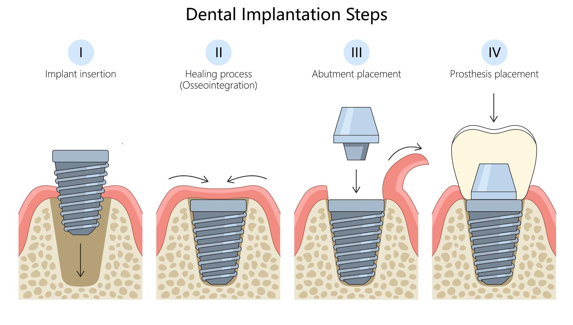 A diagram showing the steps of dental implantation