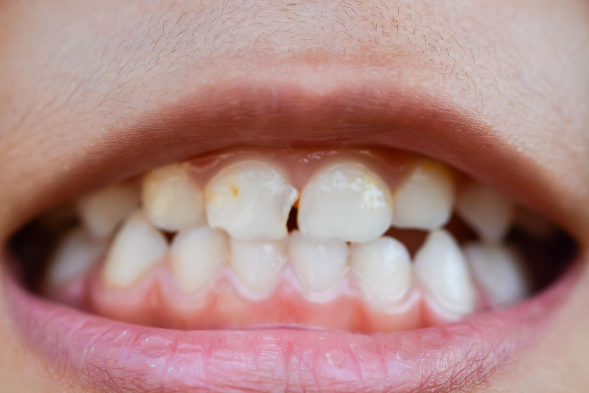 A close-up of a person's teeth with a cracked front tooth.