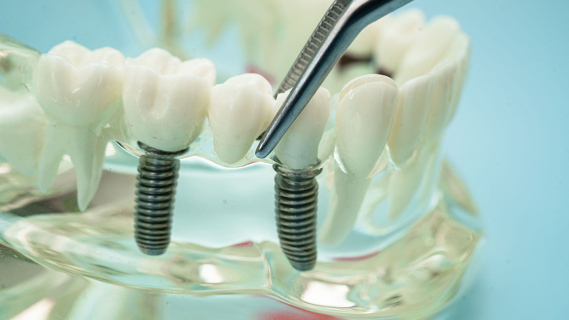 Model of dental implants; tweezers holding a tooth, with other teeth in a clear jaw model.