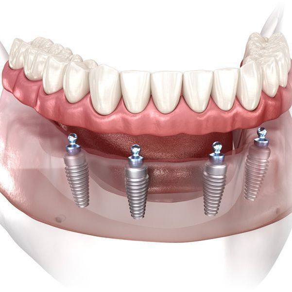 all-on-4 dental implant
