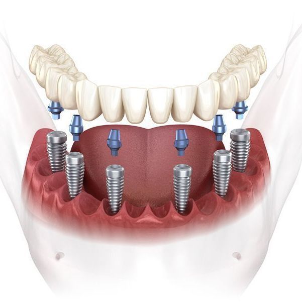 multiple tooth dental implant