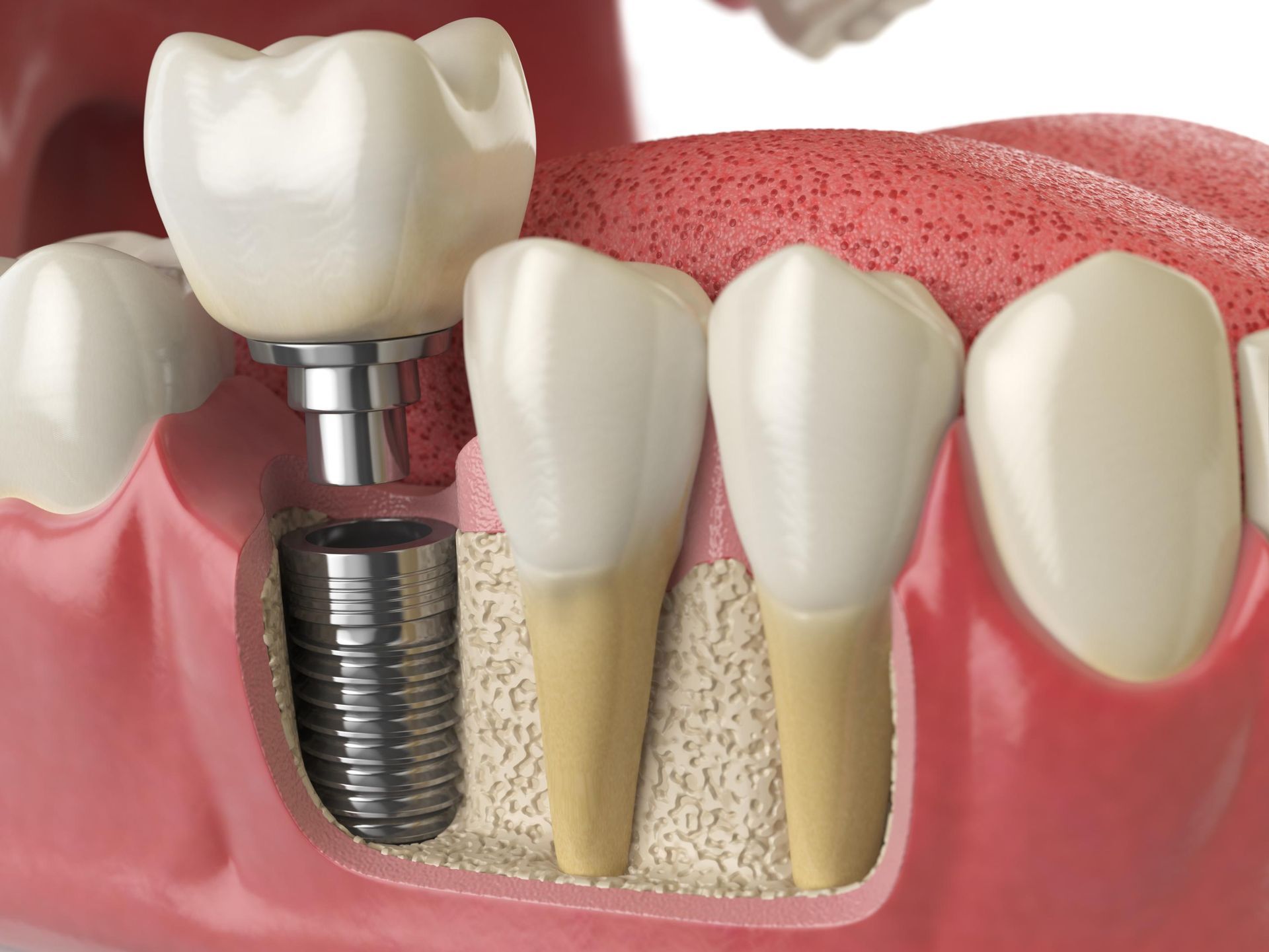 attaching the abutment and crown to a dental implant