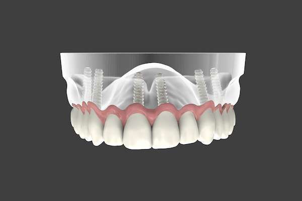 Are Implant Supported Dentures Permanent
