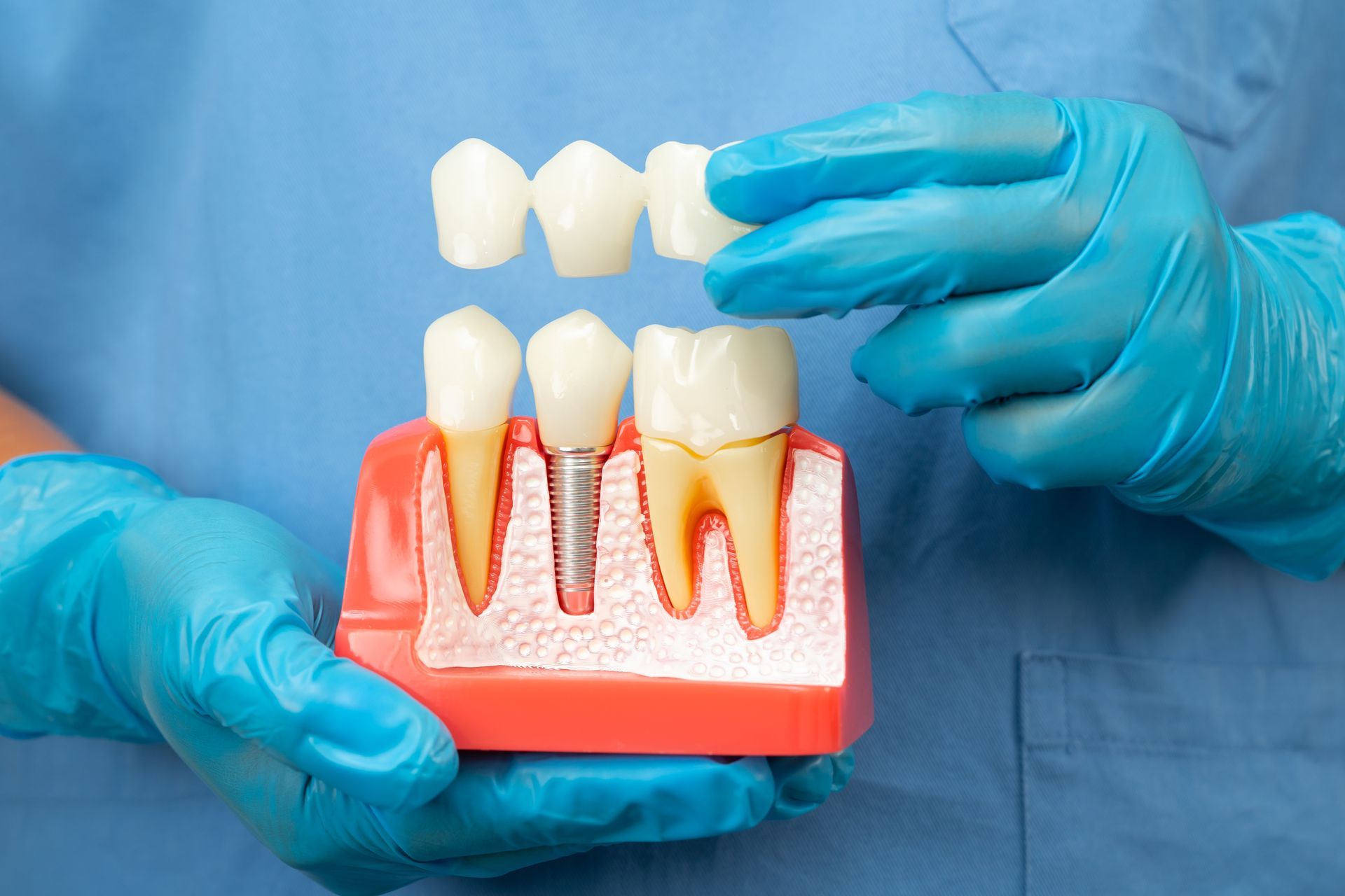 Dentist holding dental bridge model, showing a tooth implant.