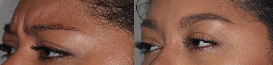 before and after botox in tucson az