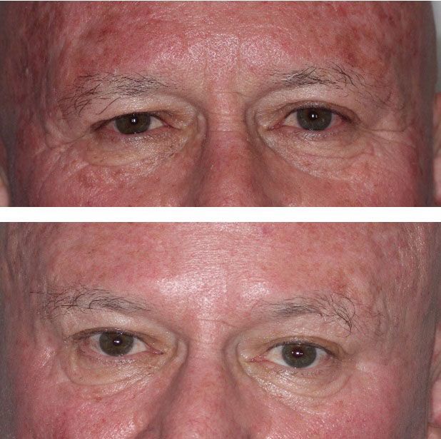 before and after botox in tucson az