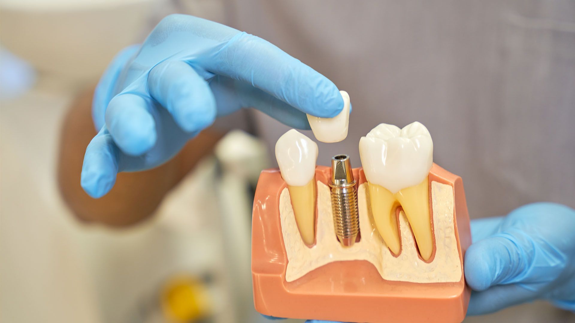 A dentist in blue gloves holds a model showing a dental implant with a crown.