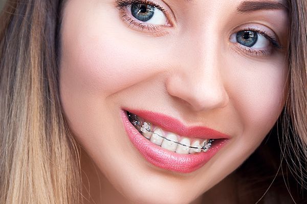 A close up of a woman 's face with braces on her teeth.