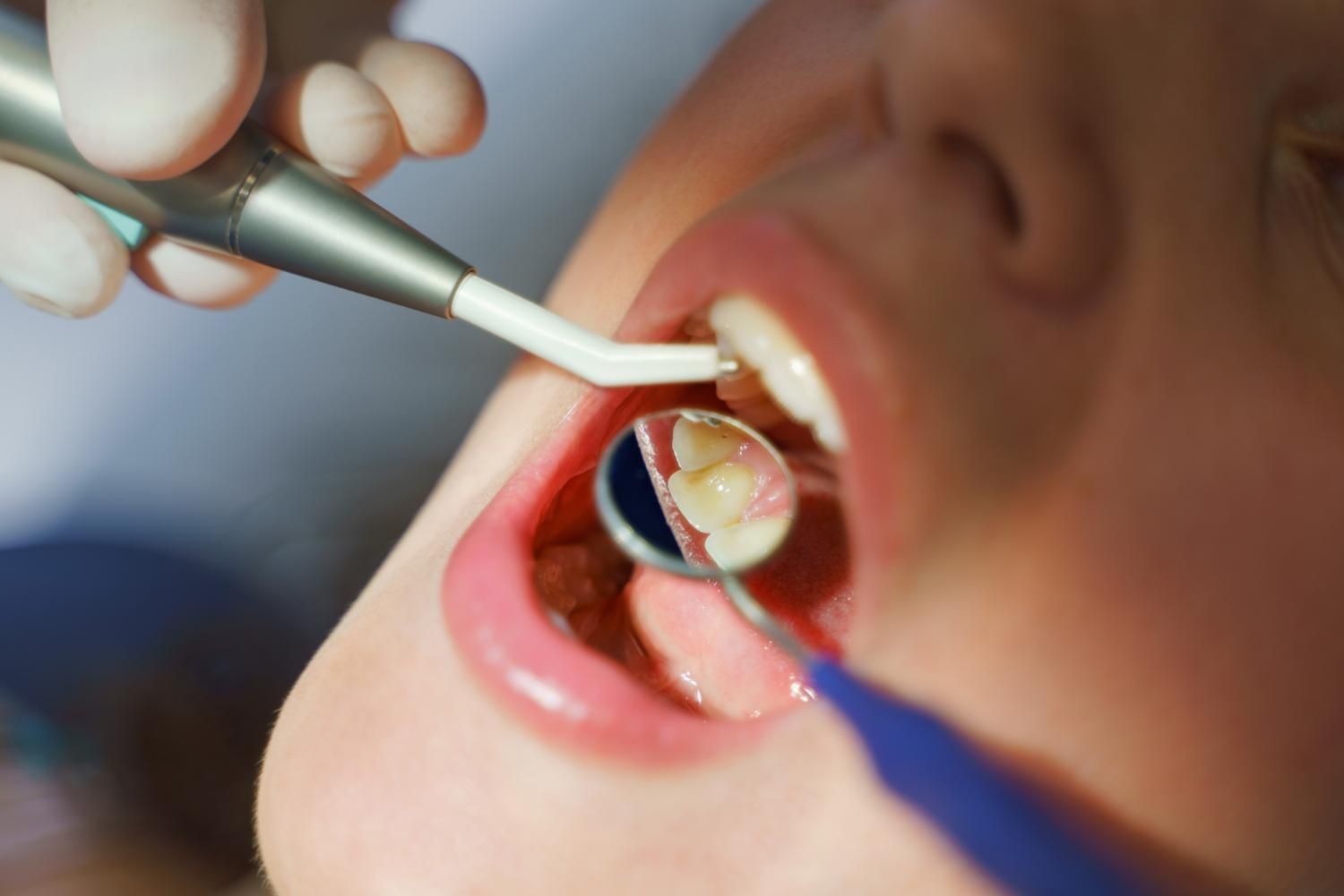 Deep dental cleaning procedure