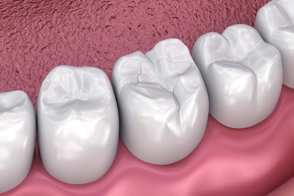 How Dental Fillings Are Used by Dentists
