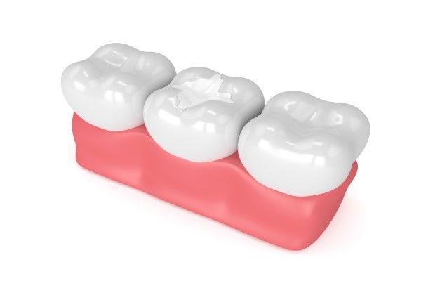 Dental Bridges