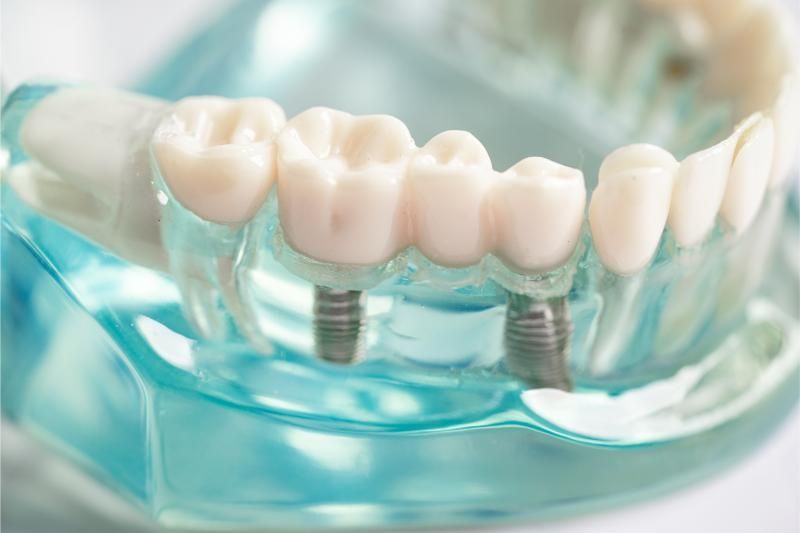 explaining the dental implant procedure.