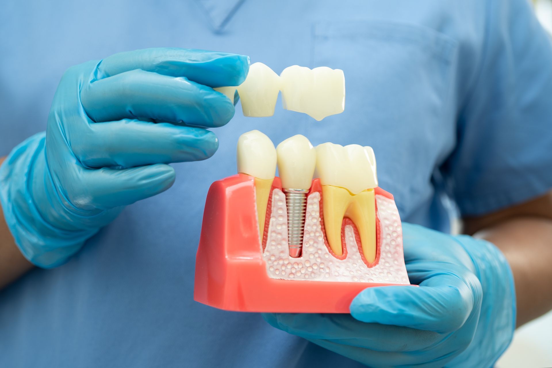Gloved hands holding a dental implant model with removable tooth crowns against a blue background