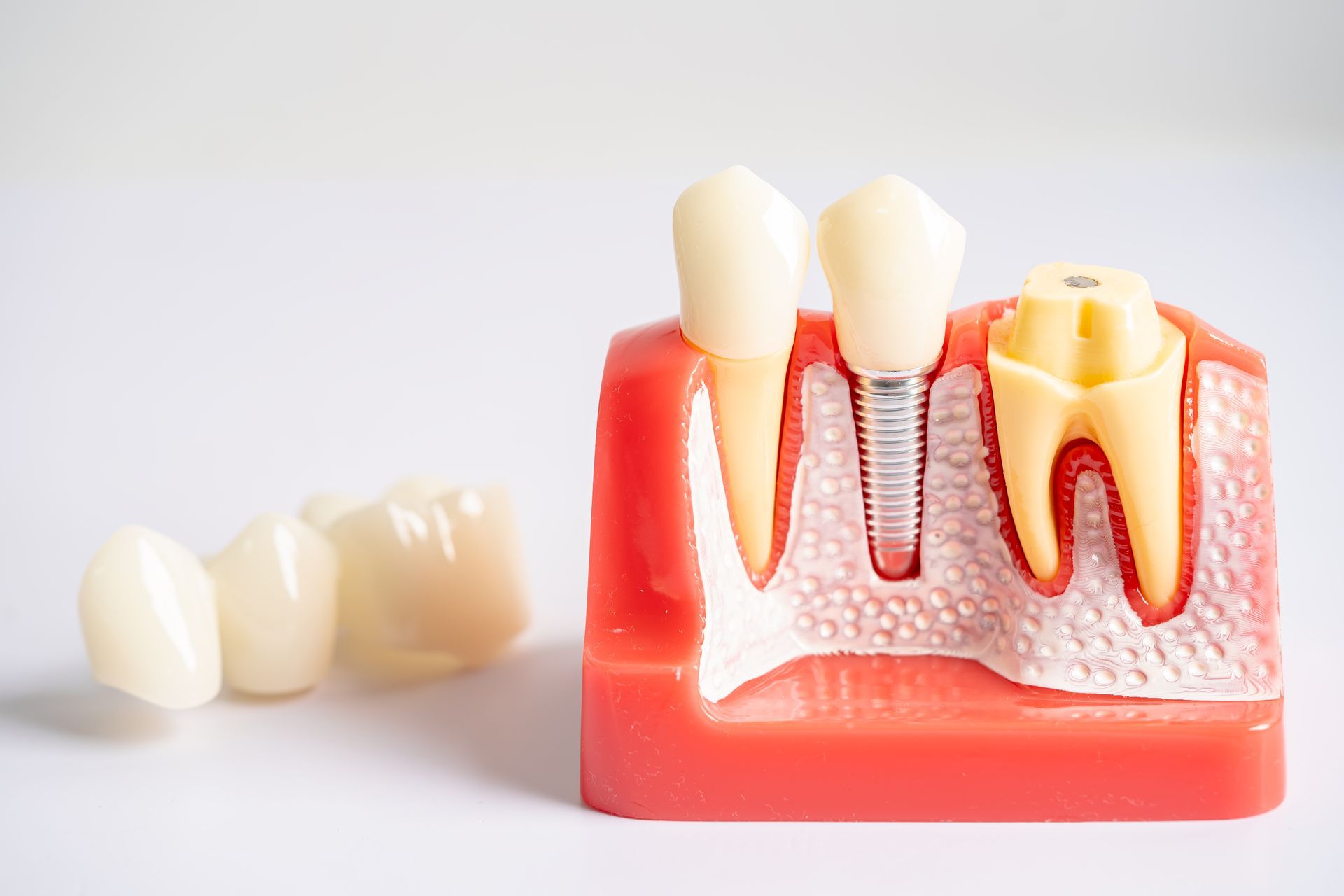 Dental implant model with two implants in pink gum model and a removable white crown on the side
