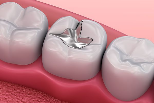 Find a Dentist for Dental Fillings
