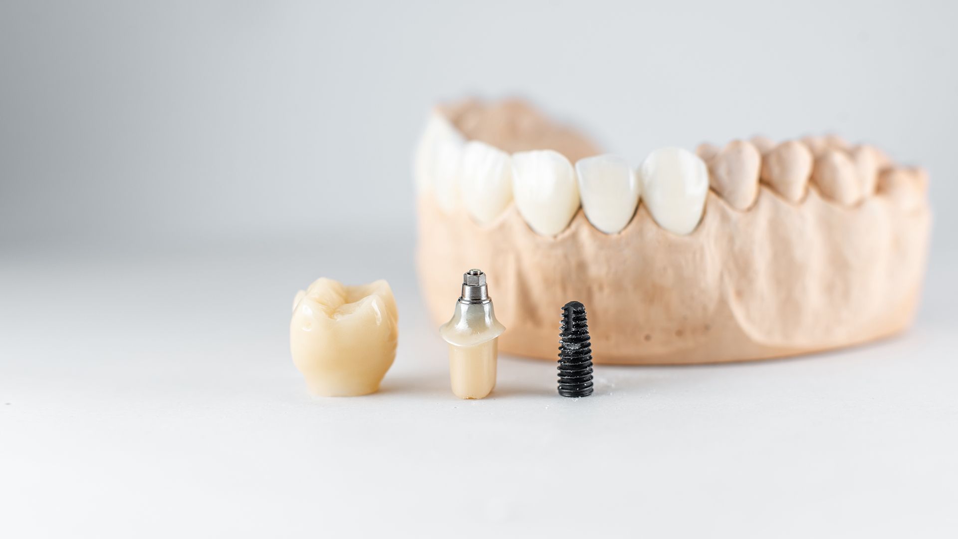 Dental implant components next to a model of teeth. A crown, implant, and screw are shown.